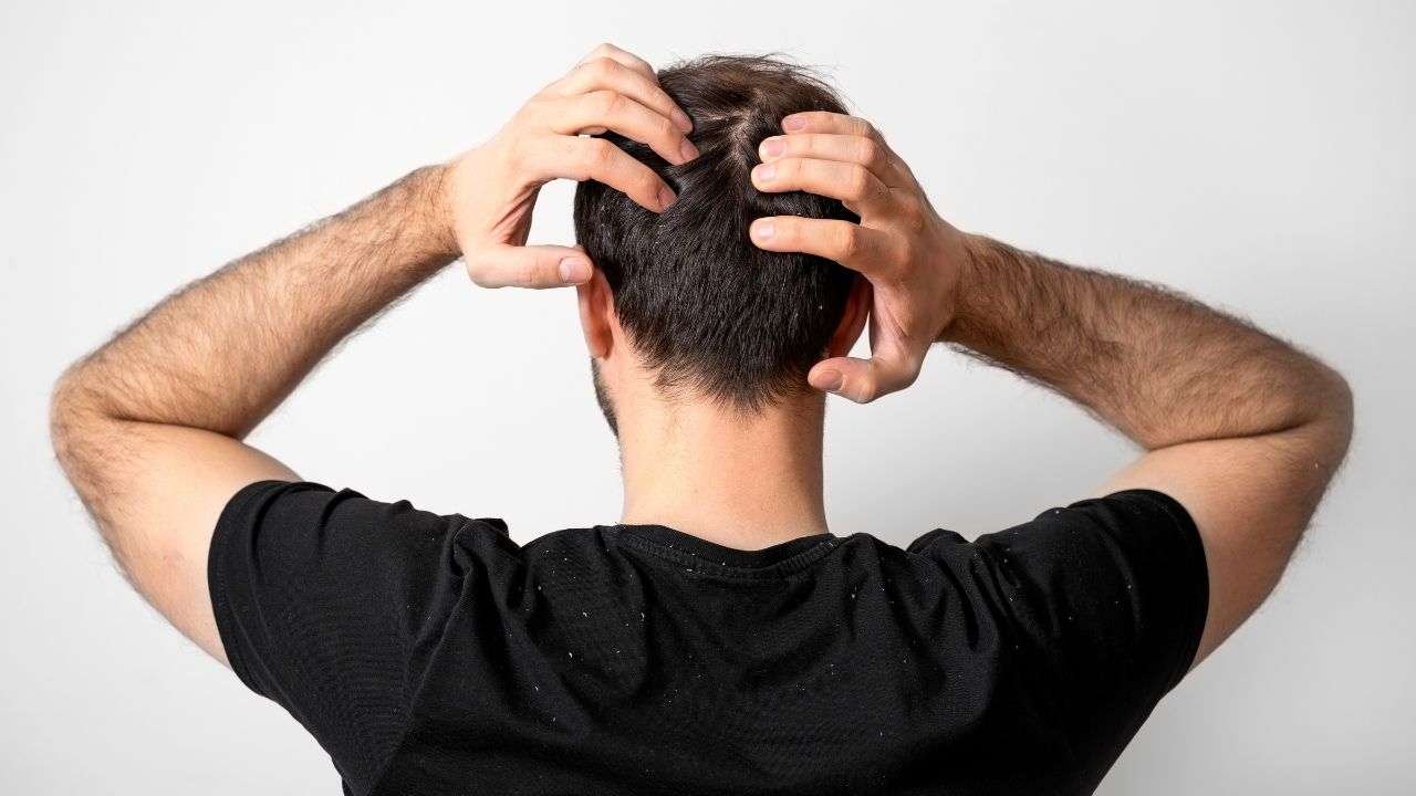 How-can-male-pattern-baldness-be-treated.