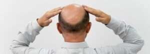 Male Pattern Baldness: Causes, Effects, and Treatments